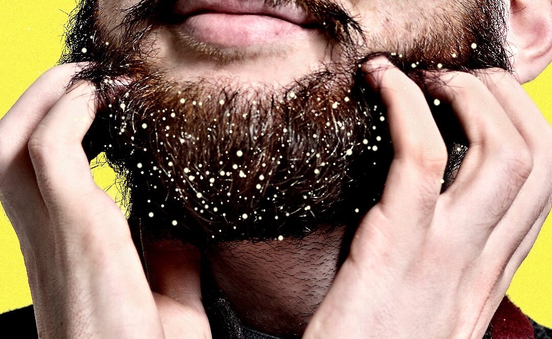 ¿Por qué tengo Caspa en la Barba?