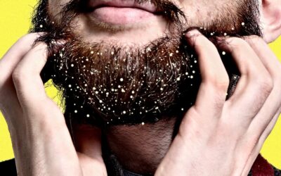 ¿Por qué tengo Caspa en la Barba?
