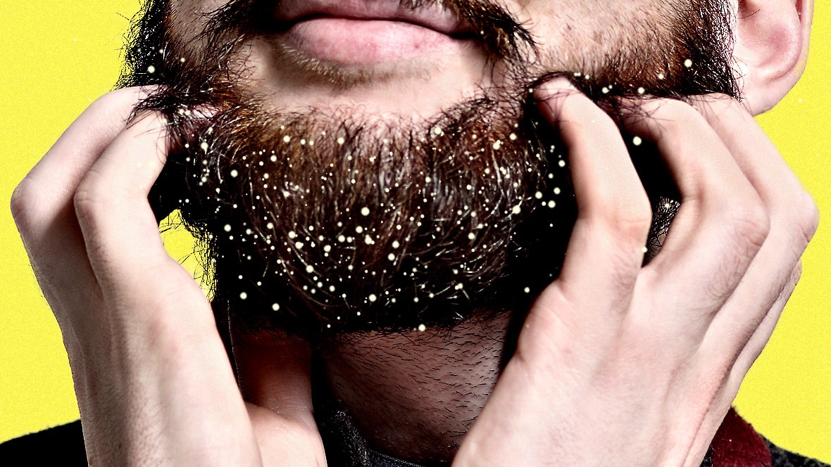 barba con caspa
