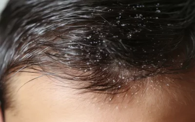 Caspa Masculina: Guía Completa para Prevenir y Eliminar la caspa