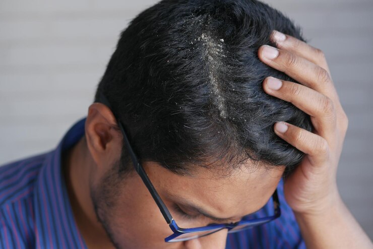 caspa masculina