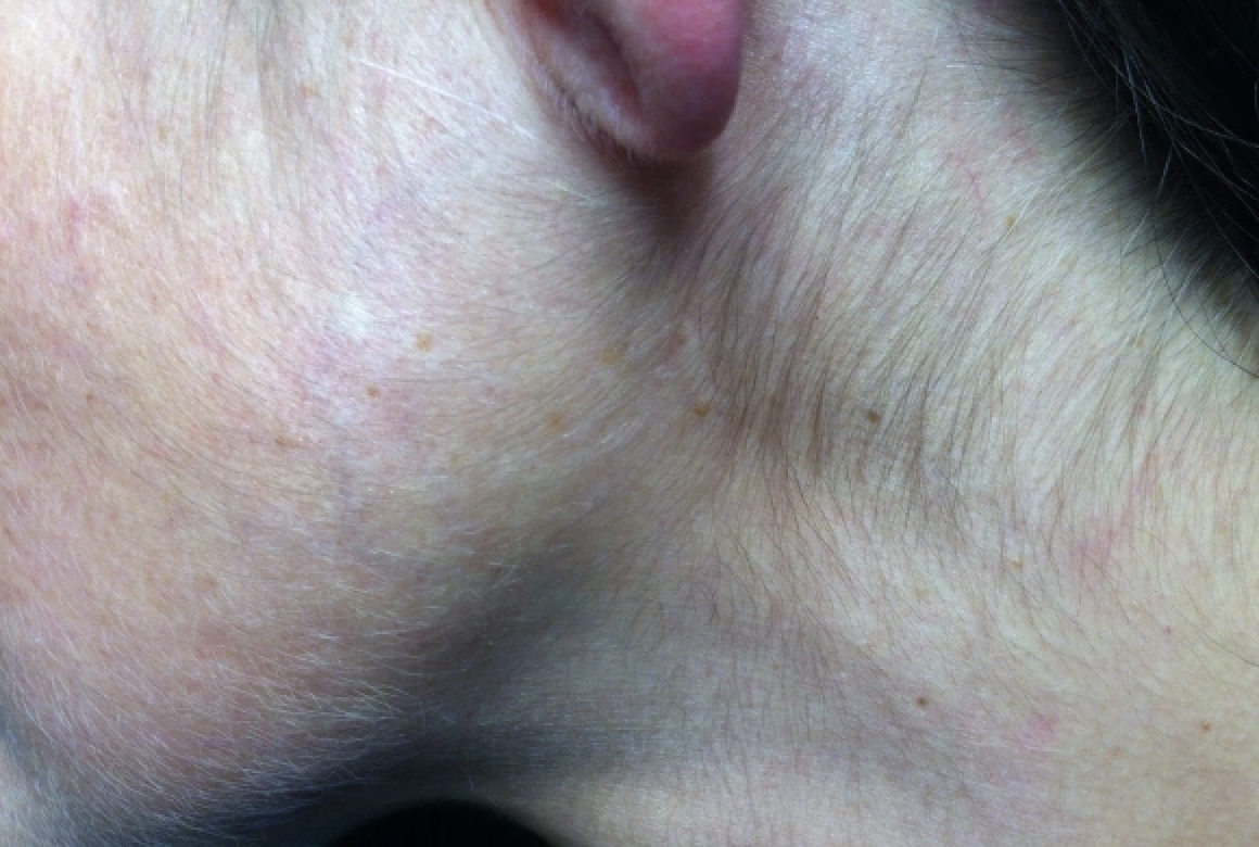 Efectos Secundarios del Minoxidil