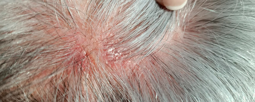Efectos Secundarios del Minoxidil